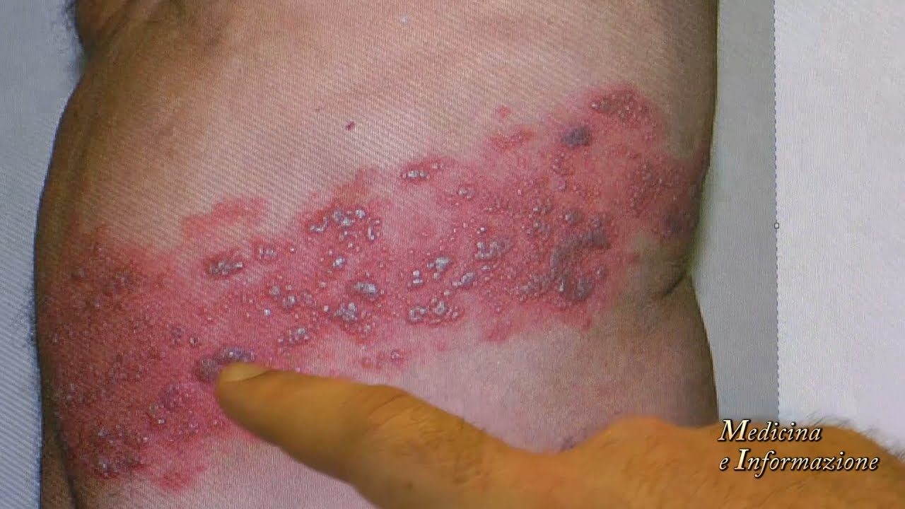 Herpes Zoster (Fuoco di Sant'Antonio): prevenirlo con il vaccino