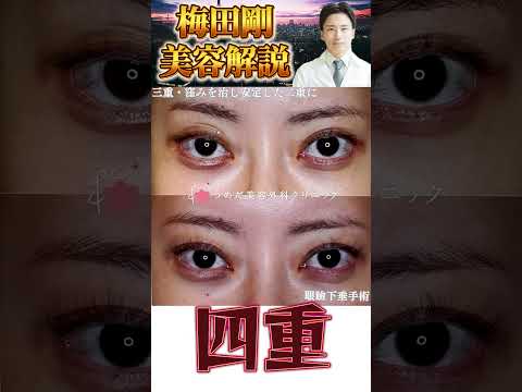 医学科 30代の眼瞼下垂　片側手術ではダメなの？！　 #美容整形 #うめだ美容外科クリニック  #眼瞼下垂
