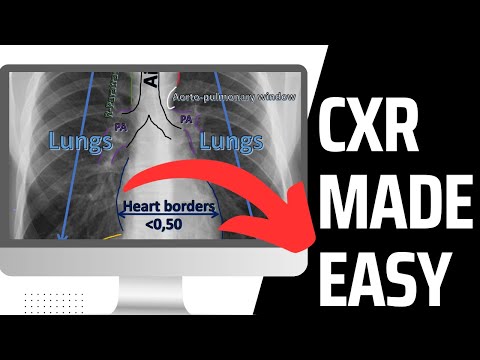Chest X-ray interpretation made EASY