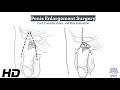 Is Penis Enlargement Surgery Worth The Risk Pros And Cons