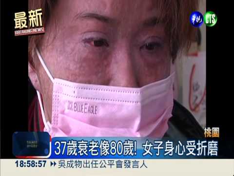 骨髓移植排斥! 37歲女衰老像80歲
