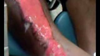 preview picture of video 'Maine's Leg After Motorcycle Wreck May '06'