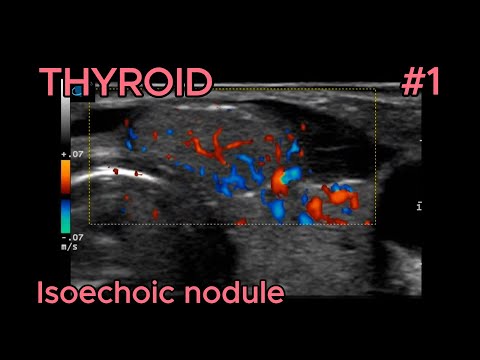 Isoechoic nodule with peripheral calcifications video preview