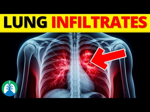 What are Lung Infiltrates? 🩻