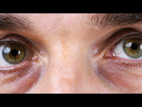 Rrathët e Zinj Nuk Formohen Vetëm Nga Pagjumësia