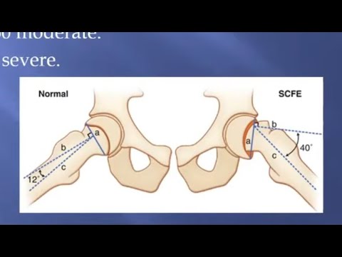 Slipped Capital femoral epiphysis for the FRCS Orth