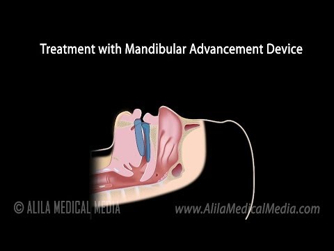 Temporomandibular Joint TMJ Anatomy and Disc Displacement Animation
