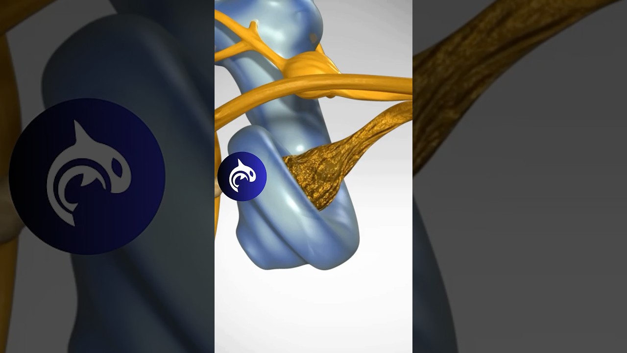 See how Hearing Loss from Nerve Degeneration works in 3D Animation.