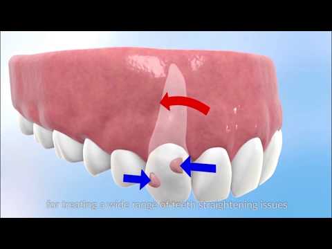 HOW WILL INVISALIGN STRAIGHTEN YOUR TEETH