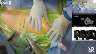 IMACx 2023 Live Surgery (Stefan Kreuzer, MD performs Total Hip Arthroplasty Using Naviswiss) INOV8
