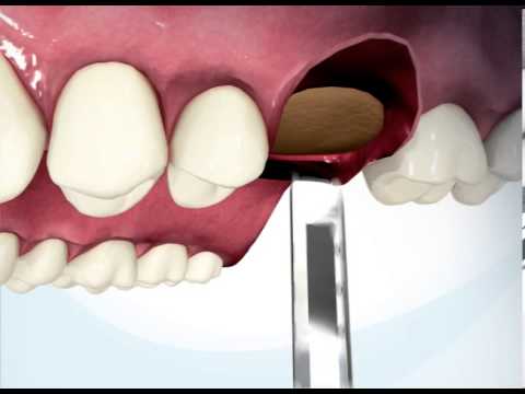 iRaise sinus lift system animation logo