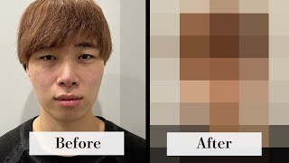 【女子必見】ハイフでお顔を小顔にしてみた！【２０代男性】
