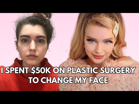 i spent $50,000 on plastic surgery bc i was ugly | FACE TRANSFORMATION