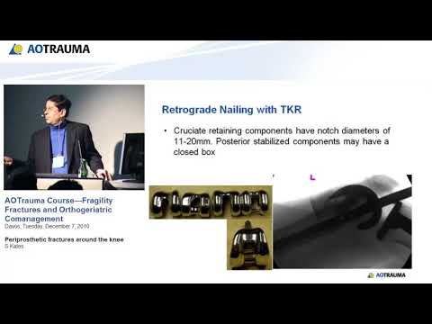 Periprosthetic fractures around the knee