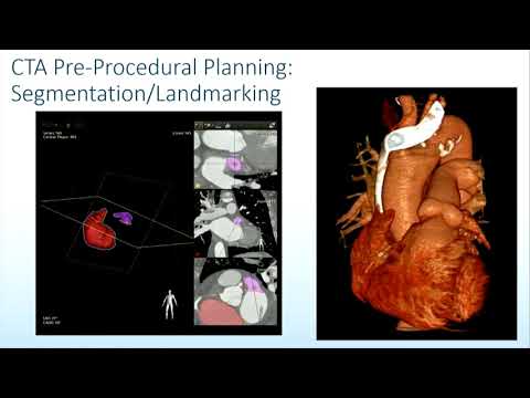 CVI 2019_Saturday, 7/20_ Passing the Limits of Occluder Therapy _Chad Kliger , MD