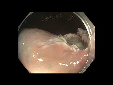 Colonoscopy: Cecum Subtle Flat Lesion