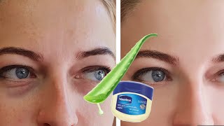 Remove under eyes dark circles, puffiness and eye bags in just 3 days|#darkcirclescream home remedy