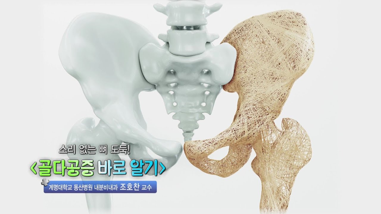 골다공증 바로 알기 | 내분비대사내과 조호찬 교수 관련사진