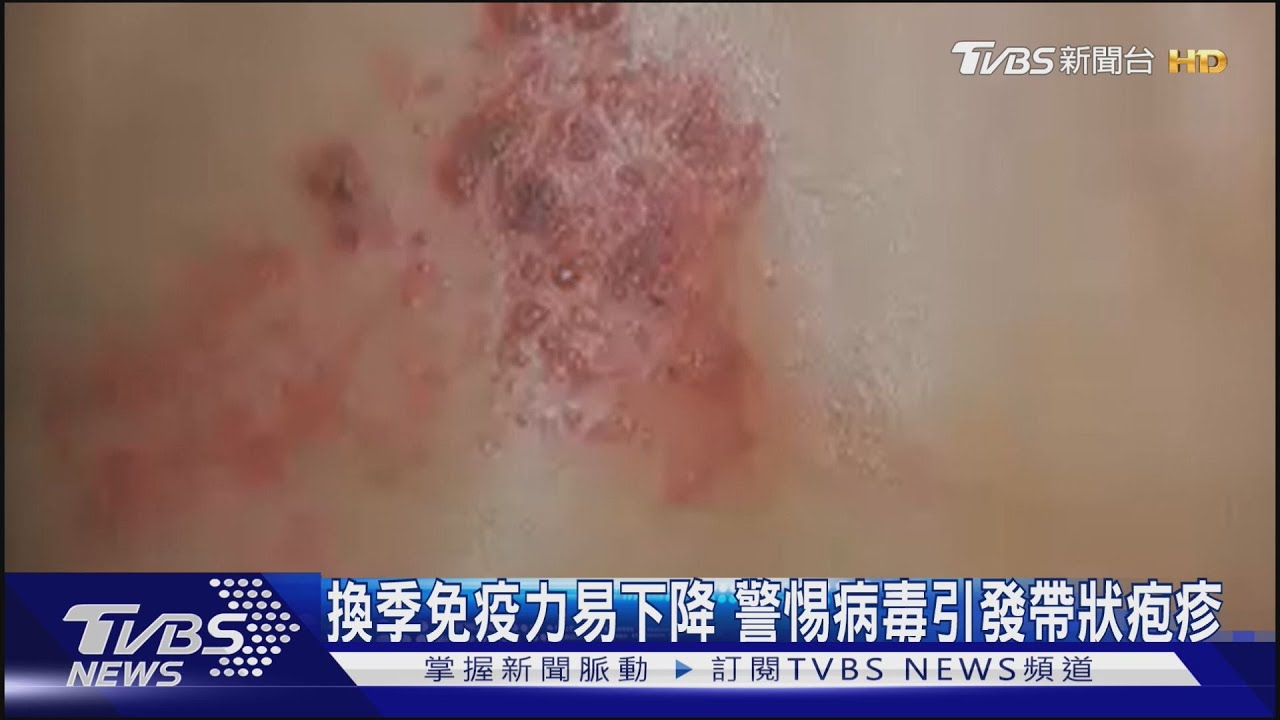 換季免疫力易下降　警惕病毒引發帶狀疱疹