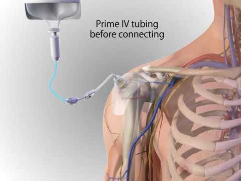 Arrow® EZ IO® System   Proximal Humerus Site IdentificationInsertion Adult, Animation