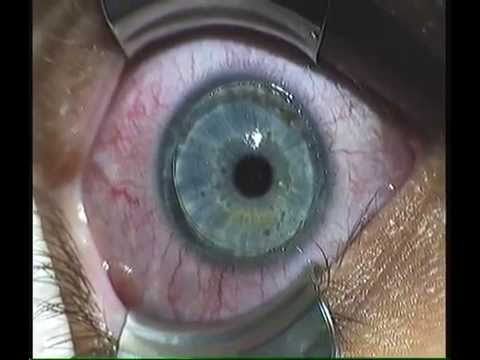 Terapie cu laser pentru vedere