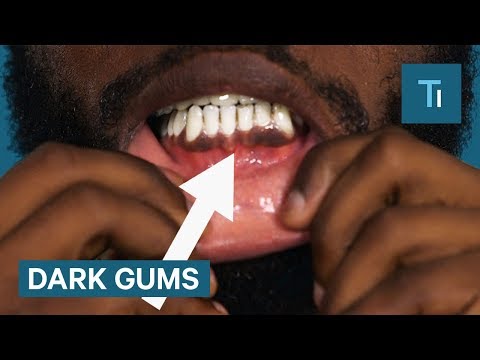 Why Some People Have Black Gums