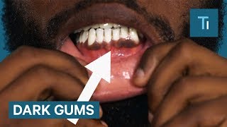 Why Some People Have Black Gums