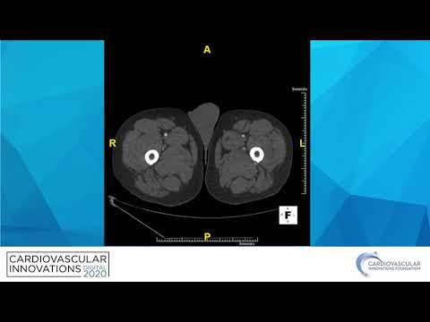 I wish I had sent this aortoiliac occlusion to surgery_Titus_Peripheral