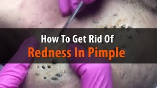 How To Get Rid Of Redness In Pimple ✦ Dr Laelia ✦