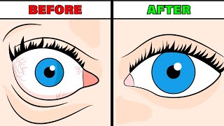 How to Reverse Thyroid Eye Disease Naturally (NO SURGERY!)