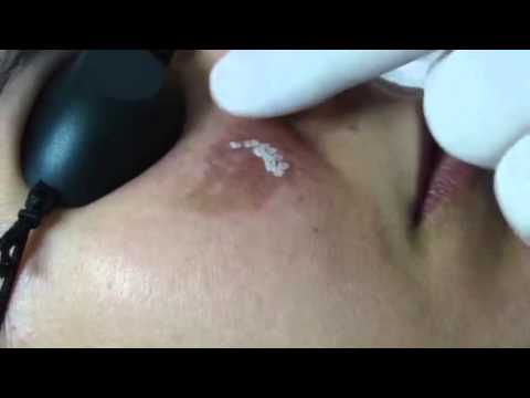 La ragazza con sorrisi di lentiggini Crema o staccandosi da posti di pigmentary