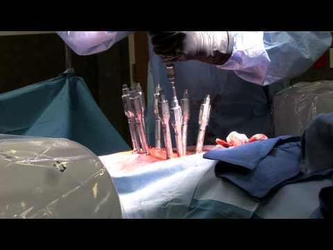 Percutaneous pedicle screws for lumbar fusion
