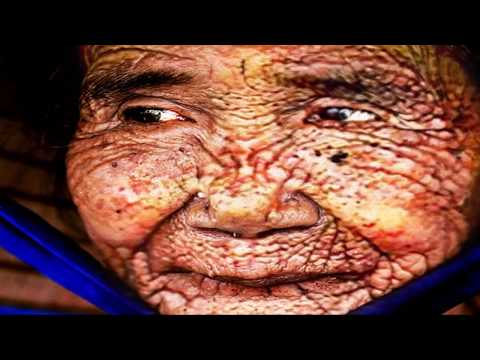 Pinunit ko ang kuko ng paa pagalingin Kaysa sa pagalingin paa halamang-singaw sa kanyang mga paa