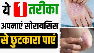 ✅ Psoriasis Causes And Treatment | ✅ Home Remedy For Psoriasis Patient | Fast Psoriasis Recovery