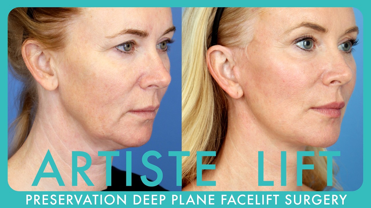 The Artiste Lift : The Future of Preservation Deep Plane Facelift Surgery Explained
