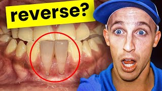 Gum Recession Because of Crossbite!? Here's What to Do!