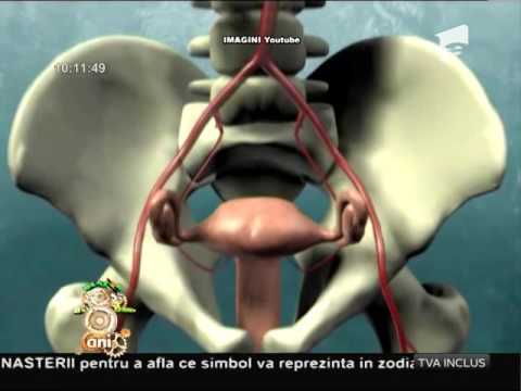 Bună dimineaţa, sănătate! Embolizarea fibromului uterin