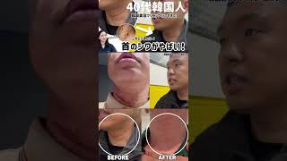 40代のひどいグビのシワ◯◯でシワがなくなりました！