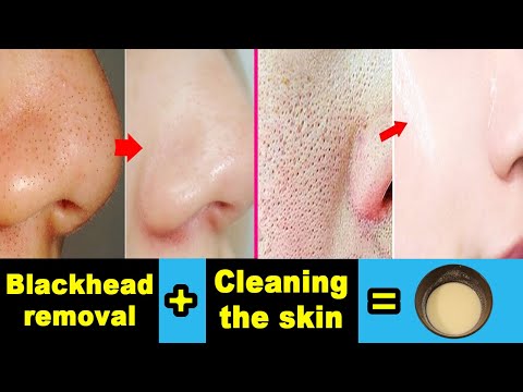 Najbolji kućni lijek za uklanjanje mitesera i čišćenje lica od nečistoća