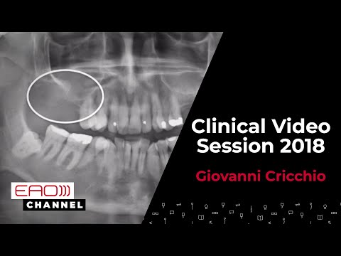 Graftless sinus floor elevation using a new implant design