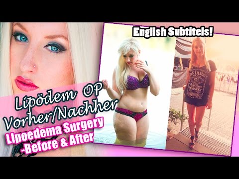 Deksalgin Bewertungen Back Pain Rückenschmerzen Muskel rechts