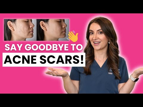 Get Rid of Acne Scars for GOOD! | Dermatologist Complete Guide to Acne Scars Treatment