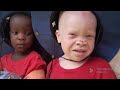 Untold Secrets About Albinism