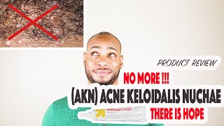Treatment / Cure for Acne Keloid Nuchae or the bumps on the back of your head.