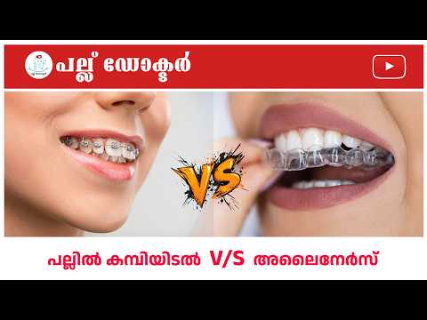 പല്ലിൽ കമ്പിയിടൽ v/s അലൈനേർസ് | ഏതാണ് മികച്ചത്? | Pallu Doctor