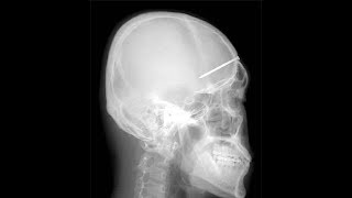 the cure splintered in her head subtitulada