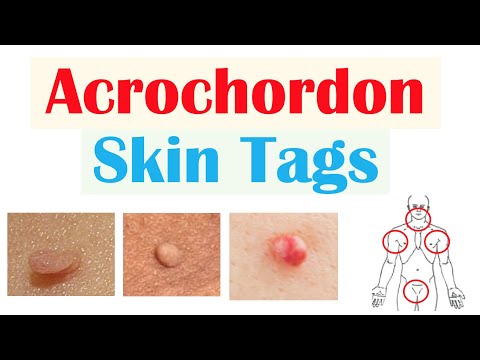 Skin Tags (Acrochordons) | Causes, Risk Factors, Symptoms, Diagnosis, Treatment