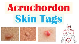 Skin Tags (Acrochordons) | Causes, Risk Factors, Symptoms, Diagnosis, Treatment