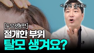 두상 성형 후 절개한 부분에 탈모가 생긴다고요..