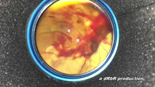 DIYretCAM - Manual focusing and dynamic retinal evaluation